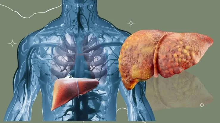 Gan nhiễm mỡ độ 1 là gì
