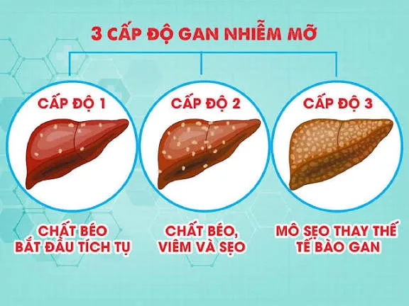 Gan nhiễm mỡ độ 1 là gì